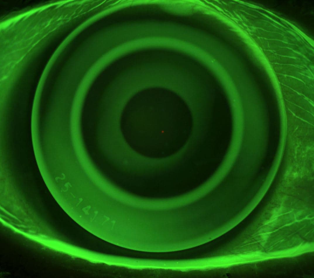 Ortho-K Fluobild.JPG